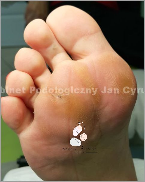 Zobacz Jak Wygląda Odcisk Z Korzeniem! Zobacz Jak Wygląda Odcisk Z Korzeniem!