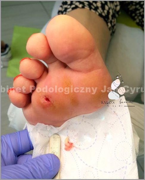 Zobacz Jak Wygląda Odcisk Z Korzeniem! Zobacz Jak Wygląda Odcisk Z Korzeniem!