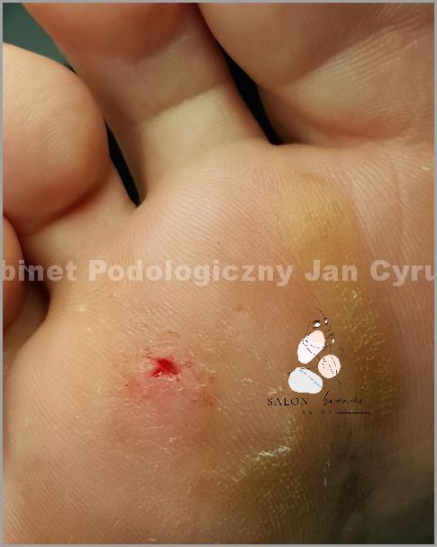 Zobacz Jak Wygląda Odcisk Z Korzeniem! Zobacz Jak Wygląda Odcisk Z Korzeniem!