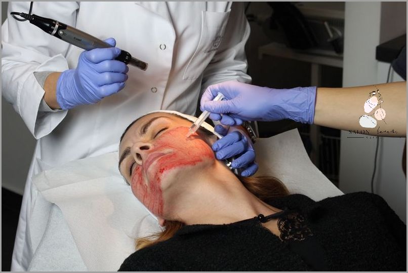 Zobacz Wampirzy Lifting Przed I Po: Zdjęcia!