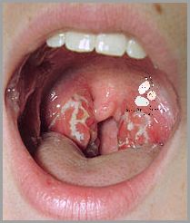 Zobacz Zdjęcia Czopów Ropnych w Gardle!