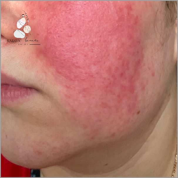 Zobacz Zdjęcia Jak Wygląda Trądzik Różowaty!