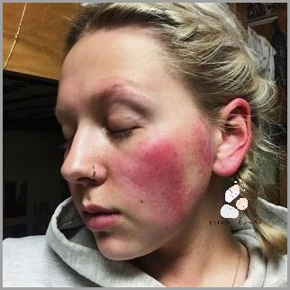 Zobacz Zdjęcia Jak Wygląda Trądzik Różowaty!