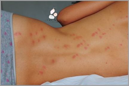 Zobacz Zdjęcia Po Ugryzieniu Pluskwy!