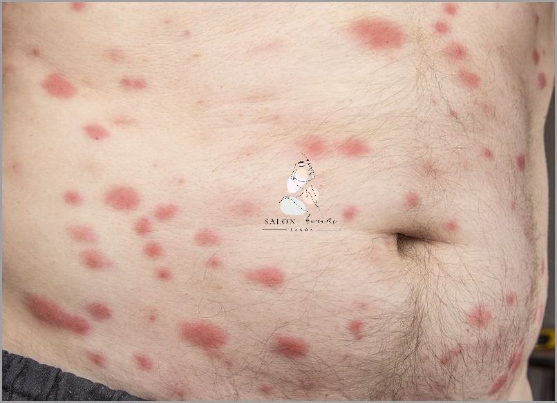 Zobacz Zdjęcia Po Ugryzieniu Pluskwy!