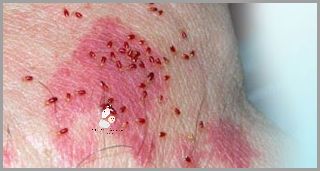 Zobacz Zdjęcia Po Ugryzieniu Pluskwy!