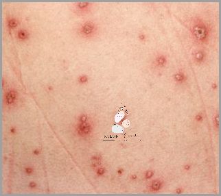 7 Domowych Sposobów Na Łojotokowe Zapalenie Skóry U Niemowląt