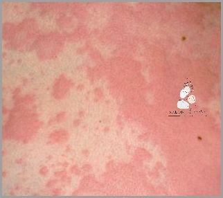 7 Domowych Sposobów Na Łojotokowe Zapalenie Skóry U Niemowląt