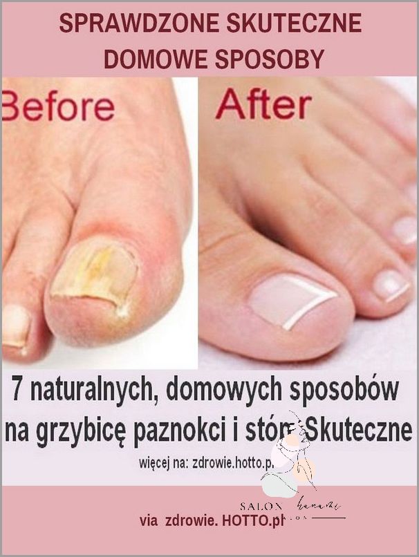 7 Skutecznych Domowych Sposobów Na Cellulit!