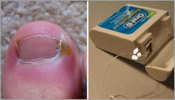 7 Skutecznych Domowych Sposobów Na Wrastający Paznokieć