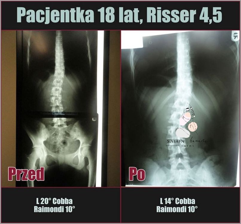 Bezoperacyjne Leczenie Przepukliny Kręgosłupa - Możliwe!