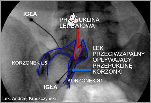 Bezoperacyjne Leczenie Przepukliny Kręgosłupa - Możliwe!