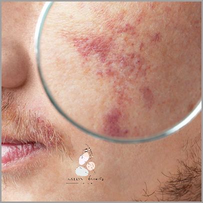 Cera Naczynkowa - Jak Wyglada?