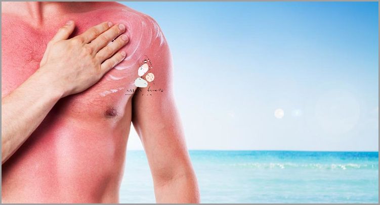 Co Na Oparzenia Słoneczne? Przekonaj Się!