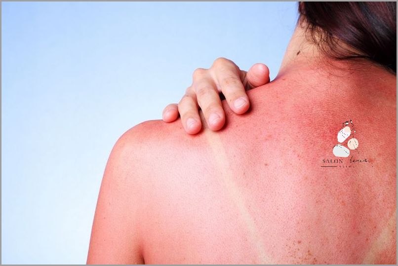 Co Na Oparzenia Słoneczne? Przekonaj Się!