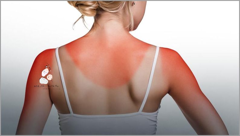 Co Na Oparzenia Słoneczne? Przekonaj Się!