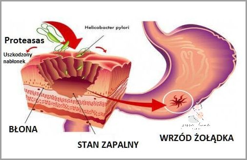 Forum: Jak skutecznie zwalczyć ból żołądka?