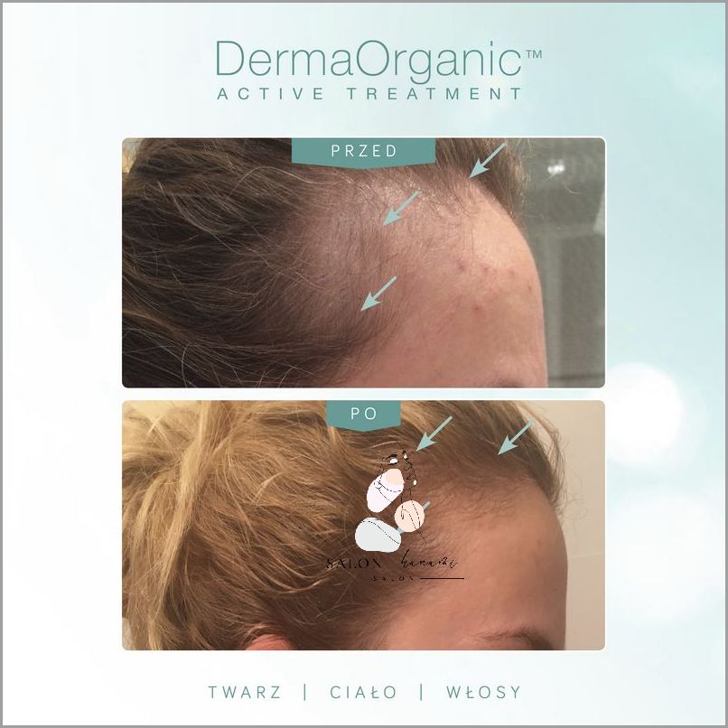 Forum: Nadmierne Wypadanie Włosów - Co Zrobić?