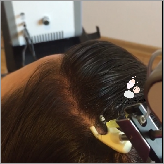 Forum: Nadmierne Wypadanie Włosów - Co Zrobić?