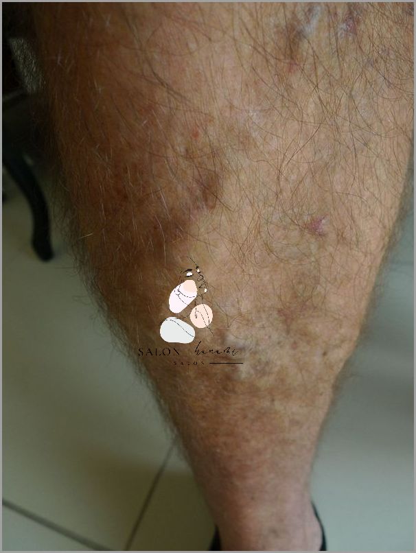 Forum Użytkowników Po Operacji Żylaków - Przeczytaj!