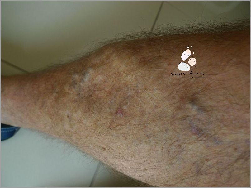 Forum Użytkowników Po Operacji Żylaków - Przeczytaj!