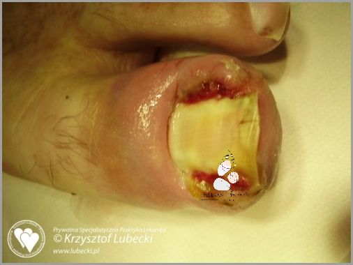 Horror! Zastrzał Palca U Dziecka!