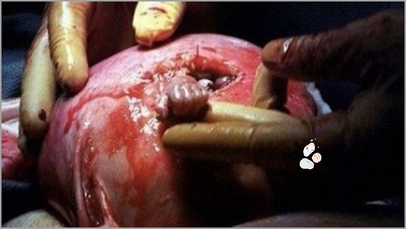 Horror! Zastrzał Palca U Dziecka!