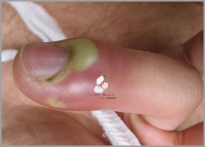 Horror! Zastrzał Palca U Dziecka!