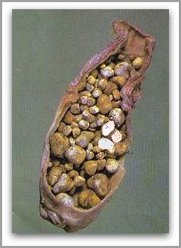 Ile Schudłyście Po Wycięciu Woreczka Żółciowego?