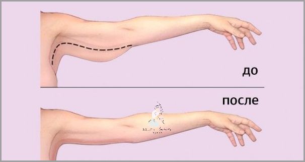 Instrukcja: Jak Schudnąć Z Ramion!