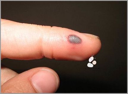 Jak Leczyć Krwiaka? Co Na Krwiaka!