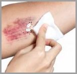 Jak Leczyć Krwiaka? Co Na Krwiaka!