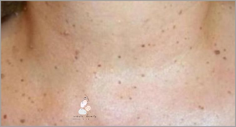 Jak Natychmiast Pozbyć Się Brodawek? Jak Natychmiast Pozbyć Się Brodawek?