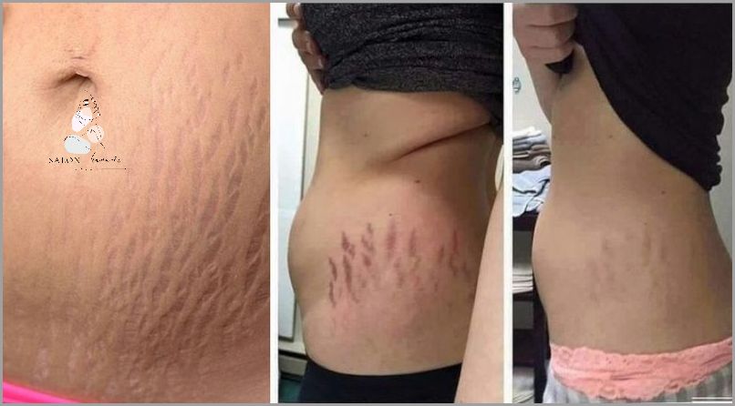 Jak Natychmiast Pozbyć Się Brodawek? Jak Natychmiast Pozbyć Się Brodawek?