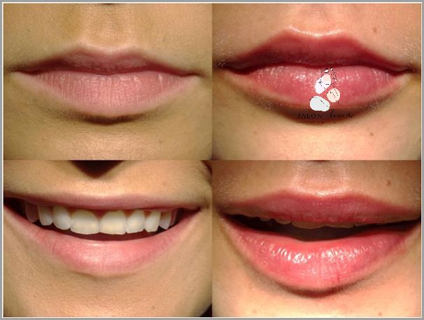 Jak Powiększyć Usta Kwasem Hialuronowym? Oto Jak!