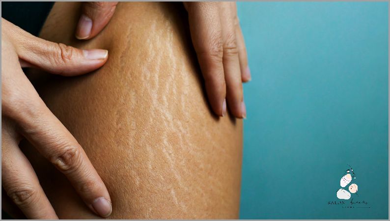 Jak Skutecznie Pozbyć Się Rozstępów U Młodzieży?