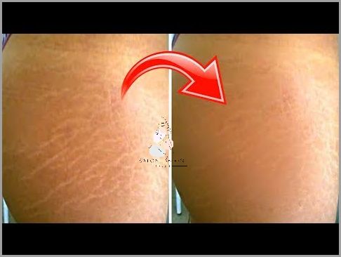 Jak Skutecznie Pozbyć Się Rozstępów U Młodzieży?