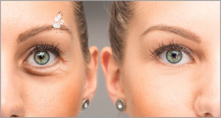 Jak Skutecznie Pozbyć Się Spuchniętych Pod Oczami? Jak Skutecznie Pozbyć Się Spuchniętych Pod Oczami?