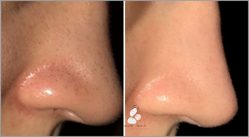 Jak Skutecznie Usunąć Zaskórniki? Jak Skutecznie Usunąć Zaskórniki?