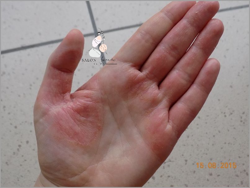 Jak wyleczyłam AZS? Forum pomoże! Jak wyleczyłam AZS? Forum pomoże!