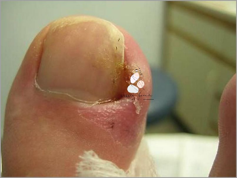 Leczenie Grzybicy Paznokci U Rak - Co Zrobić?