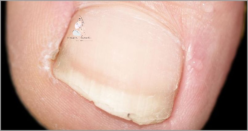 Leczenie Grzybicy Paznokci U Rak - Co Zrobić?