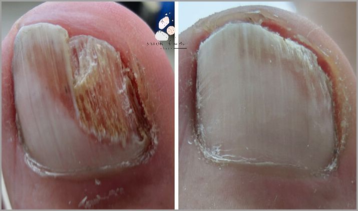 Leczenie Grzybicy Paznokci U Rak - Co Zrobić?