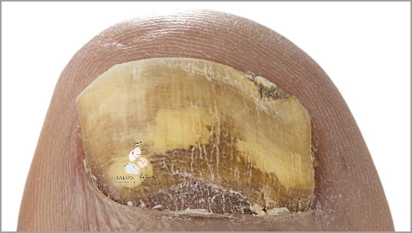 Leczenie Grzybicy Paznokci U Rak - Co Zrobić?