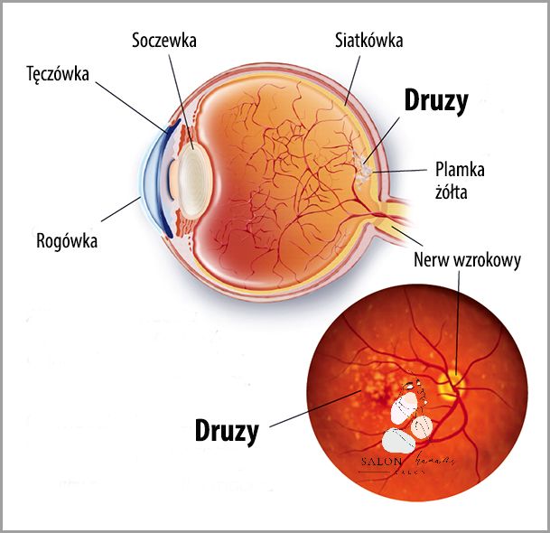 Niespodziewana Czarna Plamka W Polu Widzenia!