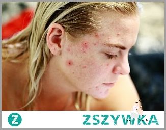 Odkryj, Skąd Się Biorą Pryszcze!
