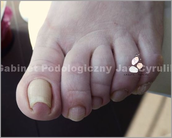 Paznokieć Odkleja Się Od Palca