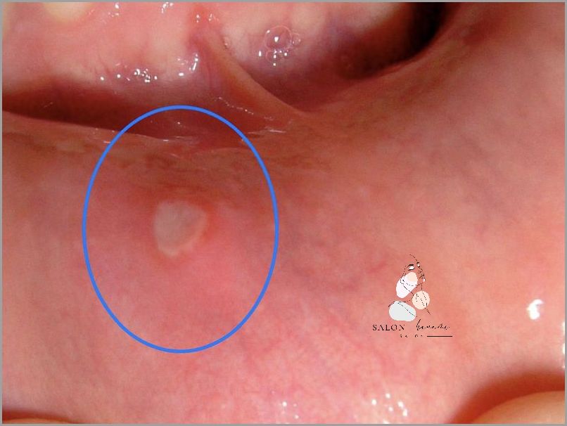 Pękanie skóry przy paznokciach - przyczyny i skuteczne leczenie.