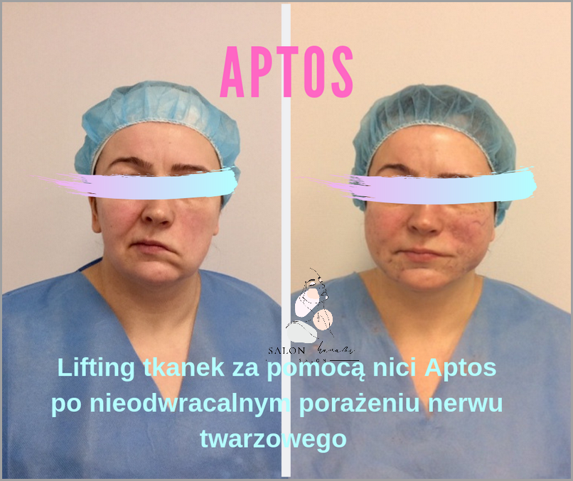 Porażenie Nerwu Twarzowego: Leczenie Domowe!