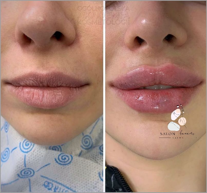 Powiększanie Ust Na Plasko - Sprawdź!